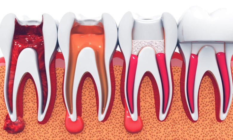 endodonti